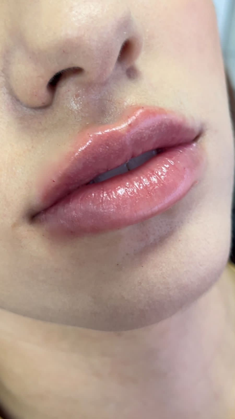 Preenchimento Labial — Contorno elegante