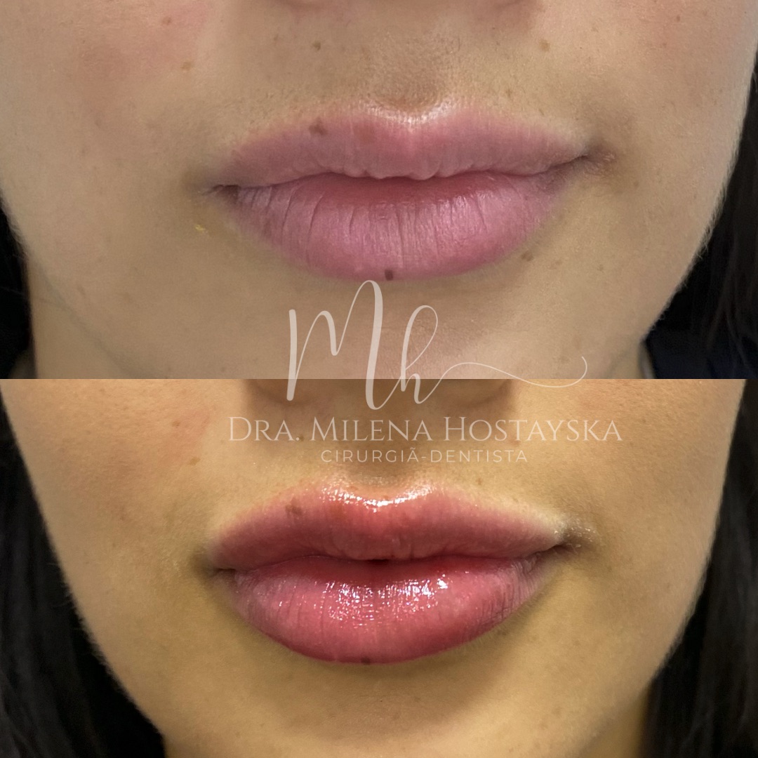 Preenchimento Labial — Antes & Depois
